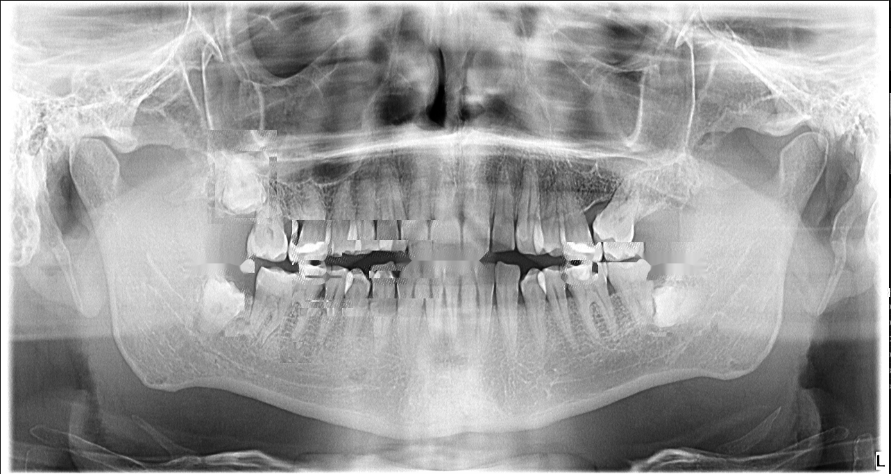 Panoramic radiograph